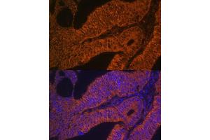 Immunofluorescence analysis of human colon carcinoma using RB antibody (ABIN6128601, ABIN6146597, ABIN6146598 and ABIN6223325) at dilution of 1:100. (RAB5B 抗体  (AA 1-215))
