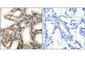 Immunohistochemical analysis of paraffin-embedded human breast carcinoma tissue using 4E-BP1(Phospho-Thr45) Antibody(left) or the same antibody preincubated with blocking peptide(right).