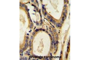 CCL4 Antibody (Center) immunohistochemistry analysis in formalin fixed and paraffin embedded human prostate carcinoma followed by peroxidase conjugation of the secondary antibody and DAB staining. (CCL4 抗体  (Middle Region))