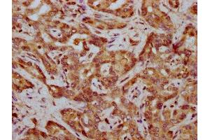IHC image of ABIN7165570 diluted at 1:400 and staining in paraffin-embedded human liver cancer performed on a Leica BondTM system. (FAM83G 抗体  (AA 464-615))