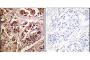 Immunohistochemistry analysis of paraffin-embedded human lung carcinoma tissue, using IKK-gamma (Ab-31) Antibody.