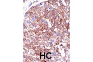 Formalin-fixed and paraffin-embedded human hepatocellular carcinoma tissue reacted with SMURF1 polyclonal antibody  , which was peroxidase-conjugated to the secondary antibody, followed by DAB staining. (SMURF1 抗体  (C-Term))
