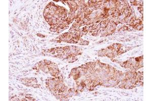 IHC-P Image Immunohistochemical analysis of paraffin-embedded human colon carcinoma, using KNP-I, antibody at 1:250 dilution. (KNP-1 (Center) 抗体)