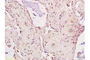 Formalin-fixed and paraffin embedded human rectal carcinoma labeled Anti-LDL receptor Polyclonal Antibody, Unconjugated  at 1:200, followed by conjugation to the secondary antibody and DAB staining (LDLR 抗体  (AA 781-860))