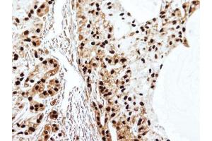 IHC-P Image Immunohistochemical analysis of paraffin-embedded A549 xenograft, using SET antibody, isoform 2-specifc , at 1:100 dilution. (SET/TAF-I 抗体  (N-Term))