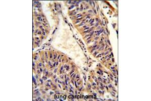Formalin-fixed and paraffin-embedded human lung carcinoma reacted with ALG14 Antibody , which was peroxidase-conjugated to the secondary antibody, followed by DAB staining. (ALG14 抗体  (AA 67-93))