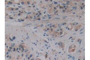 DAB staining on IHC-P; Samples: Human Prostate cancer Tissue (ALOX15B 抗体  (AA 253-490))