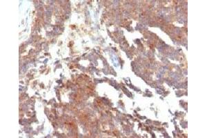 IHC testing of FFPE human ovarian carcinoma and GnRHR antibody (clone LCHR37) (GNRHR 抗体)