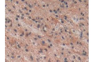 DAB staining on IHC-P; Samples: Human Glioma Tissue (Tachykinin 3 抗体  (AA 23-121))