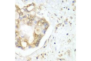 Immunohistochemistry of paraffin-embedded human liver cancer using VTI1B antibody. (VTI1B 抗体)