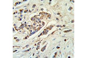 ABCC11 antibody IHC analysis in formalin fixed and paraffin embedded breast carcinoma. (ABCC11 抗体  (AA 343-372))