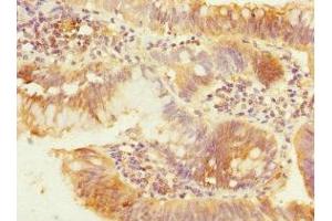 Immunohistochemistry of paraffin-embedded human colon cancer using ABIN7162961 at dilution of 1:100 (PEX19 抗体  (AA 1-299))