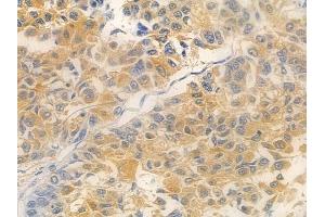 ABIN7095030 and ABIN7099086 at 1/100 staining human lung squamous cell carcinoma by IHC-P. (TMEM199 抗体)