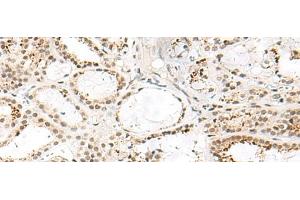 Immunohistochemistry of paraffin-embedded Human thyroid cancer tissue using FKBP5 Polyclonal Antibody at dilution of 1:50(x200) (FKBP5 抗体)