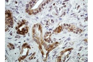 IHC-P Image Immunohistochemical analysis of paraffin-embedded Human pancreatic tumor, using CXCR7, antibody at 1:100 dilution. (CXCR7 抗体)