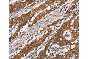 Immunohistochemistry of Human thyroid cancer using DSC2 Polyclonal Antibody at dilution of 1:35 (Desmocollin 2 抗体)