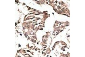 Formalin-fixed and paraffin-embedded human cancer tissue reacted with the primary antibody, which was peroxidase-conjugated to the secondary antibody, followed by AEC staining. (ATG4C 抗体  (N-Term))