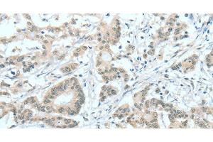 Immunohistochemistry of paraffin-embedded Human colon cancer tissue using ASH2L Polyclonal Antibody at dilution 1:60 (ASH2L 抗体)