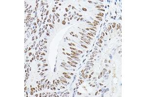 Immunohistochemistry of paraffin-embedded human colon carcinoma using YE Rabbit pAb (ABIN6130808, ABIN6150331, ABIN6150332 and ABIN6221925) at dilution of 1:100 (40x lens). (GAS41 抗体  (AA 1-227))