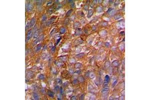 Immunohistochemical analysis of c-CBL (pY774) staining in human breast cancer formalin fixed paraffin embedded tissue section. (CBL 抗体  (C-Term, pTyr774))