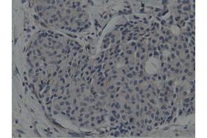 Immunohistochemical staining of paraffin-embedded Adenocarcinoma of Human breast tissue using anti-SH3GL1 mouse monoclonal antibody. (SH3GL1 抗体)