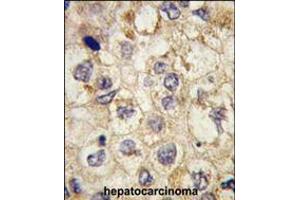 Formalin-fixed and paraffin-embedded human hepatocarcinoma tissue reacted with SSR1 antibody , which was peroxidase-conjugated to the secondary antibody, followed by DAB staining. (SSR1 抗体  (N-Term))