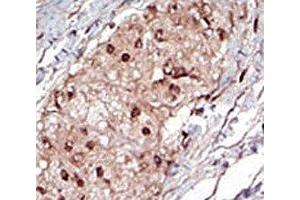 IHC analysis of FFPE human hepatocarcinoma tissue stained with the SPHK1 antibody (SPHK1 抗体  (AA 286-315))