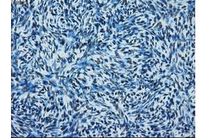 Immunohistochemical staining of paraffin-embedded Adenocarcinoma of colon tissue using anti-ERCC1 mouse monoclonal antibody. (ERCC1 抗体)