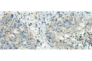 Immunohistochemistry of paraffin-embedded Human cervical cancer tissue using PAK1IP1 Polyclonal Antibody at dilution of 1:120(x200) (PAK1IP1 抗体)
