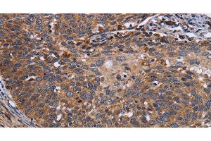 Immunohistochemistry of paraffin-embedded Human cervical cancer tissue using LRRC15 Polyclonal Antibody at dilution 1:60 (LRRC15 抗体)