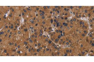 Immunohistochemistry of paraffin-embedded Human liver cancer tissue using NPRL2 Polyclonal Antibody at dilution 1:50 (NPRL2 抗体)