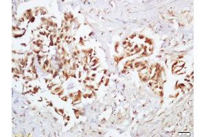 Formalin-fixed and paraffin embedded human colon carcinoma labeled with Rabbit Anti-Ep300 (Ser1834) Polyclonal Antibody, Unconjugated (ABIN800613) at 1:200 followed by conjugation to the secondary antibody and DAB staining