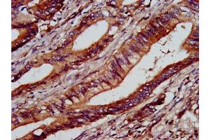 IHC image of ABIN7154230 diluted at 1:1000 and staining in paraffin-embedded human colon cancer performed on a Leica BondTM system. (C1GALT1 抗体  (AA 34-143))