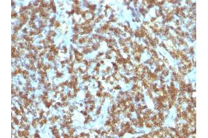Formalin-fixed, paraffin-embedded human Lymphoma stained with CD45RO Monoclonal Antibody (SPM125). (CD45 抗体)