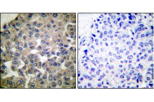 Immunohistochemical analysis of paraffin-embedded human breast carcinoma tissue using PLCG1 (Ab-771) antibody. (Phospholipase C gamma 1 抗体)