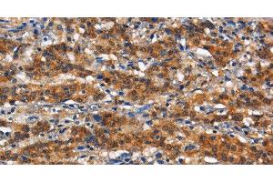 Immunohistochemistry of paraffin-embedded Human gasrtic cancer tissue using CD13 Polyclonal Antibody at dilution 1:80 (CD13 抗体)