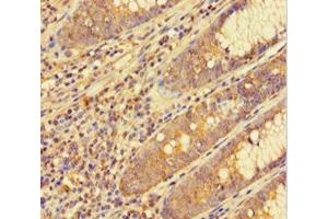 Immunohistochemistry of paraffin-embedded human colon cancer using ABIN7153793 at dilution of 1:100 (GTF2F1 抗体  (AA 1-249))