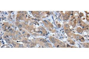 Immunohistochemistry of paraffin-embedded Human breast cancer tissue using CXCL5 Polyclonal Antibody at dilution of 1:45(x200) (CXCL5 抗体)