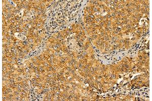 ABIN6264534 and ABIN6272895 at 1/100 staining Human lung cancer by IHC-P.