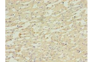 Immunohistochemistry of paraffin-embedded human liver cancer using ABIN7149554 at dilution of 1:100 (DAPK2 抗体  (AA 222-370))