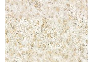 ABIN6261305 and ABIN6276929 at 1/100 staining human glioblastoma by IHC-P. (DKC1 抗体  (Internal Region))