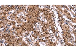 Immunohistochemistry of paraffin-embedded Human gasrtic cancer tissue using ID4 Polyclonal Antibody at dilution 1:40 (ID4 抗体)