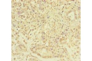 Immunohistochemistry of paraffin-embedded human pancreatic cancer using ABIN7169347 at dilution of 1:100 (SERPINB6 抗体  (AA 180-300))