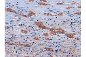 Detection of ICAM1 in Human Liver cancer Tissue using Polyclonal Antibody to Intercellular Adhesion Molecule 1 (ICAM1)