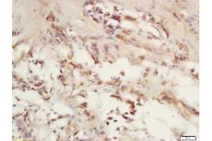 Formalin-fixed and paraffin embedded human laryngeal carcinoma labeled with Rabbit Anti-COX6c/Cytochrome C Oxidase subunit VIc Polyclonal Antibody, Unconjugated (ABIN1714715) at 1:200 followed by conjugation to the secondary antibody and DAB staining (COX6C 抗体  (AA 21-75))
