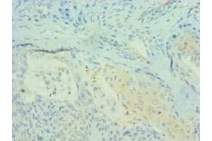 Immunohistochemistry of paraffin-embedded human breast cancer using ABIN7164694 at dilution of 1:100 (PDCD4 抗体  (AA 1-260))