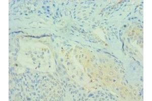 Immunohistochemistry of paraffin-embedded human breast cancer using ABIN7164694 at dilution of 1:100