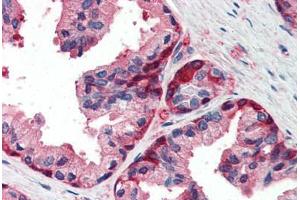 Human Prostate (formalin-fixed, paraffin-embedded) stained with GSTP1 antibody ABIN337104 at 5 ug/ml followed by biotinylated anti-goat IgG secondary antibody ABIN481715, alkaline phosphatase-streptavidin and chromogen. (GSTP1 抗体  (AA 22-33))