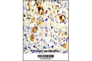 Formalin-fixed and paraffin-embedded human breast carcinoma with MMP19 Antibody , which was peroxidase-conjugated to the secondary antibody, followed by DAB staining. (MMP19 抗体  (C-Term))
