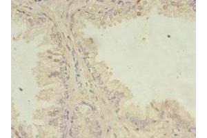 Immunohistochemistry of paraffin-embedded human prostate cancer using ABIN7165657 at dilution of 1:100 (ITPRID2 (AA 1-267) 抗体)
